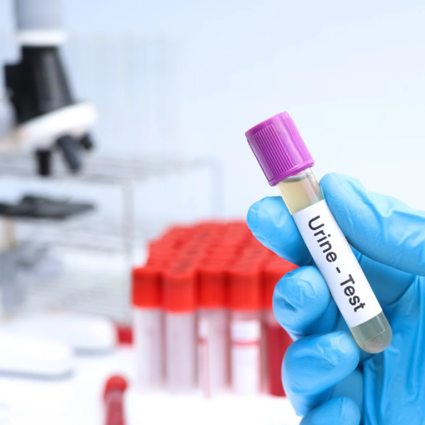 UA (Urinalysis) Test