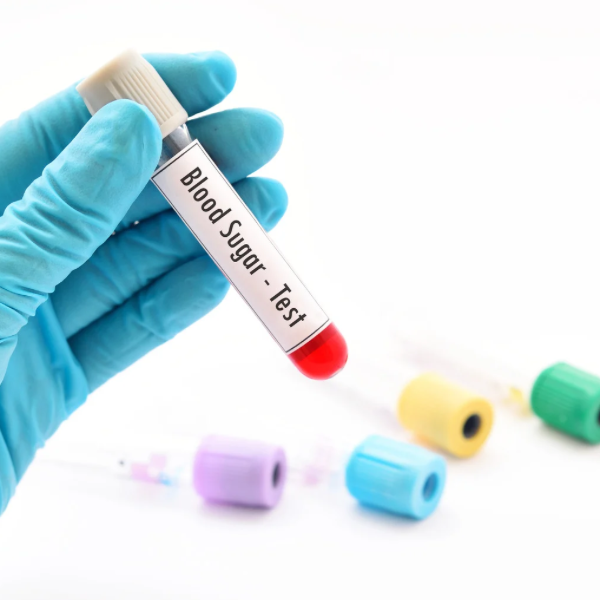 FBS (Fasting Blood Sugar) Test